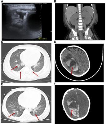 Clinical features and management of atypical hemolytic uremic syndrome patient with DGKE gene variants: a case report